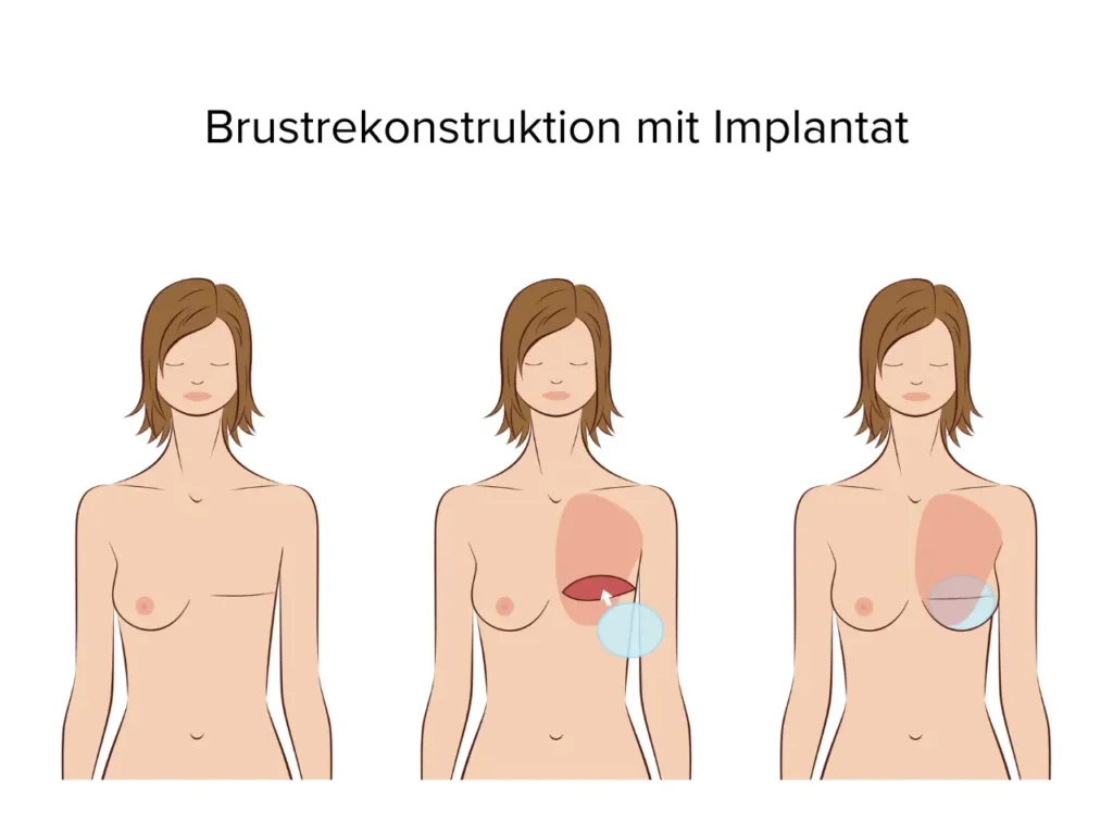 Brustrekonstruktion Wien