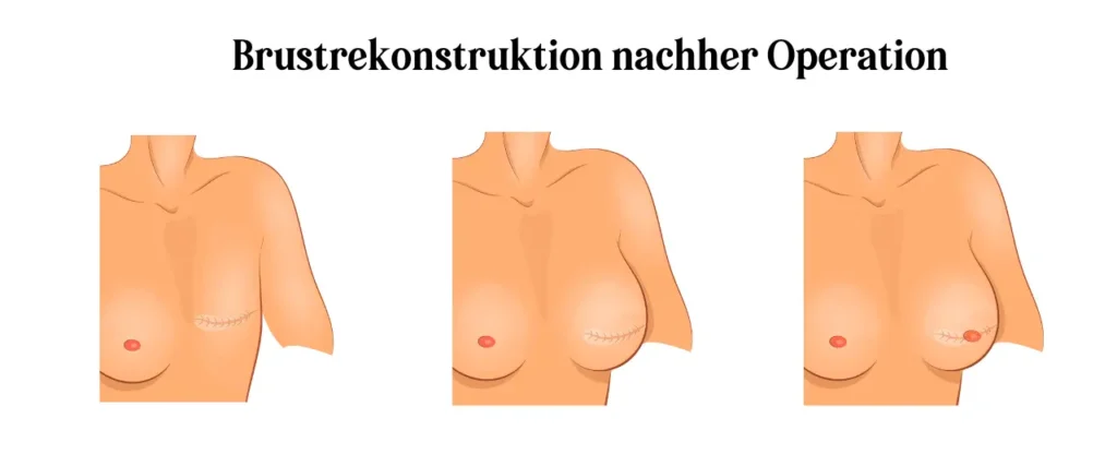 Brustrekonstruktion in Wien