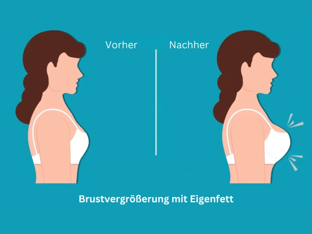 Brustvergrößerung mit Eigenfett