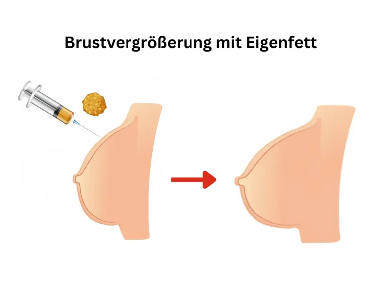 Brustvergrößerung mit Eigenfett