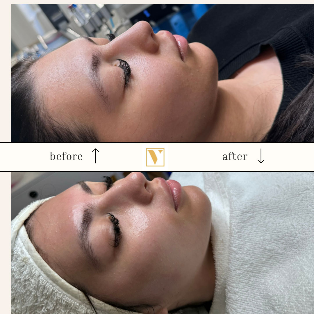 HydraFacialinWien Dr Najib Chichakli HydraFacial in Wien
