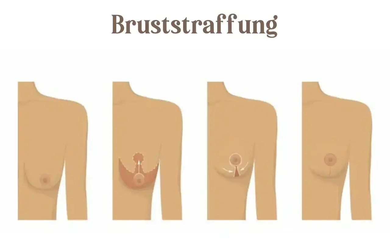 Bruststraffung Wien