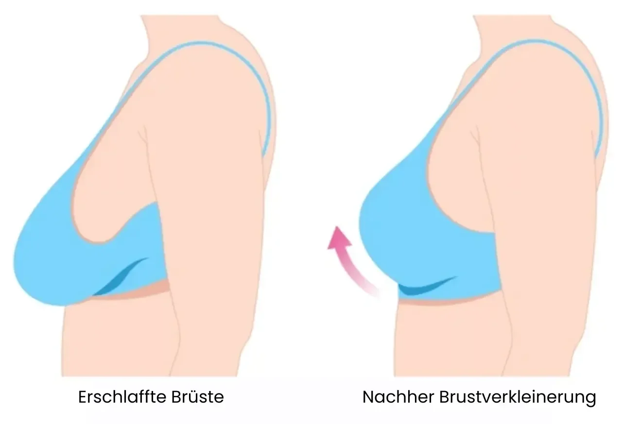 Bruststraffung Wien