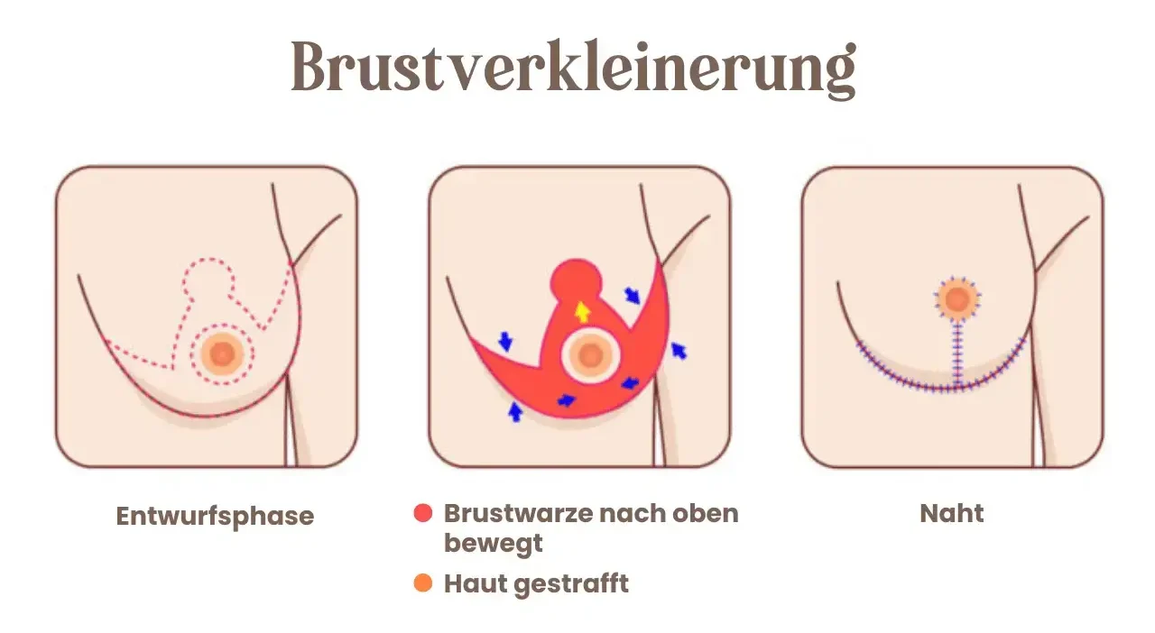 Brustverkleinerung Wien
