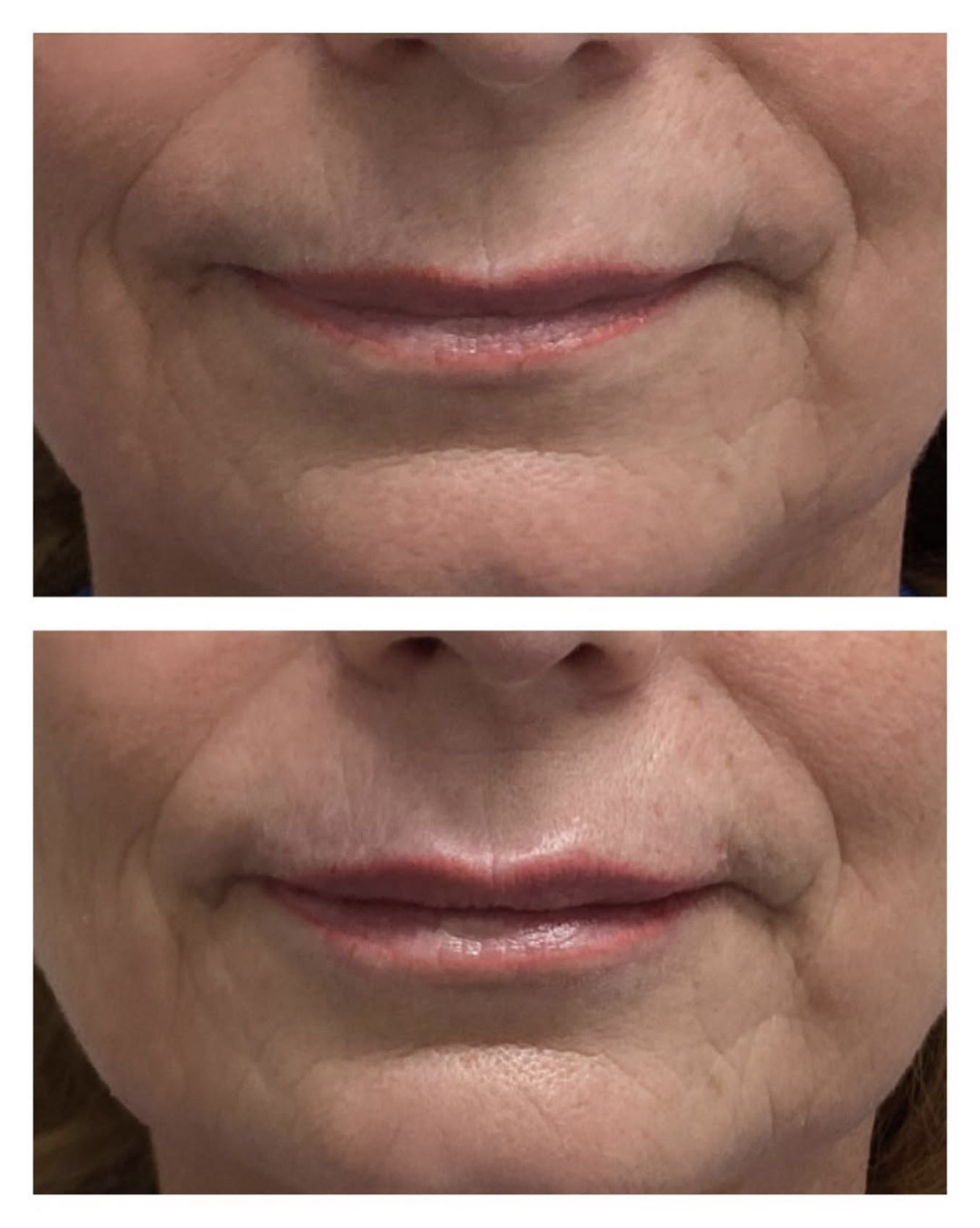 Lippen aufspritzen vorher nachher