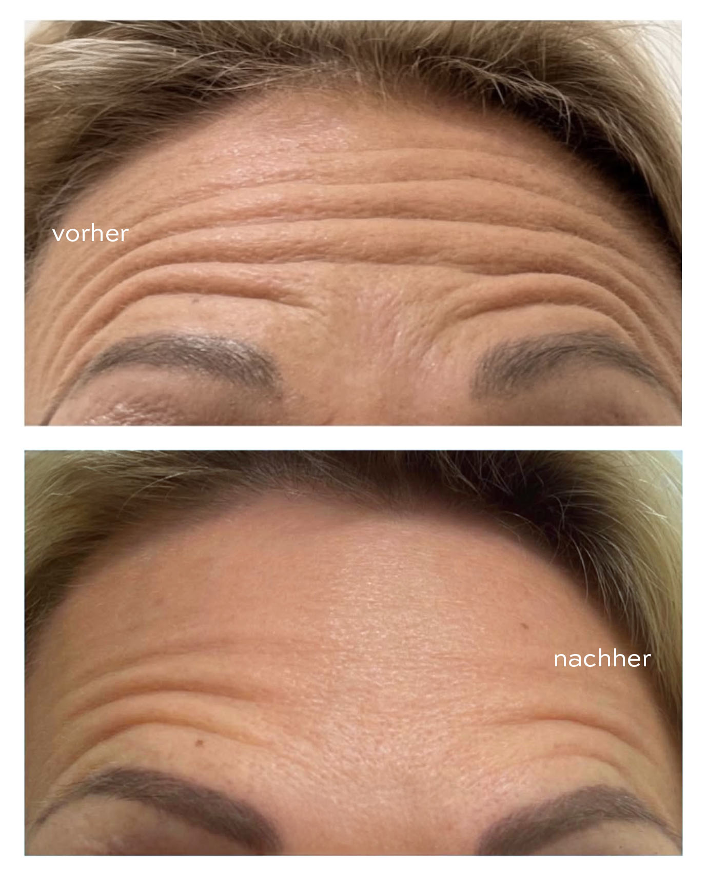 Faltenbehandlung Wien – Stirnfalten before und after