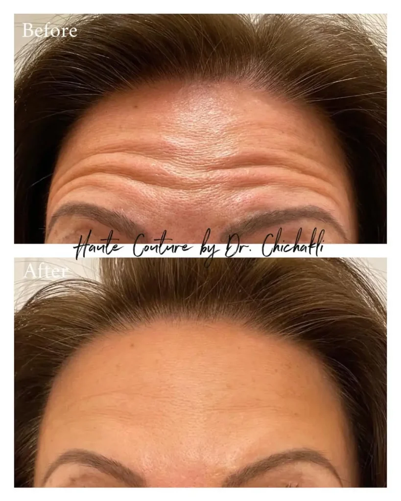 Faltenbehandlung Wien Botox Stirn Botox Behandlung Wien