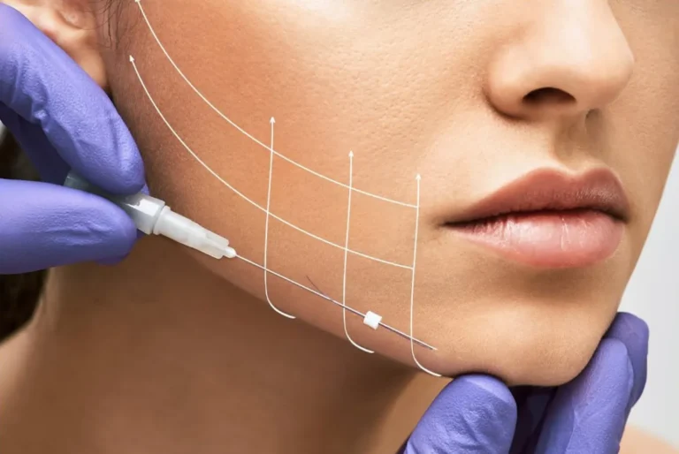 Fadenlifting Wien Jawline Filler Unterschied zwischen Botox und Filler