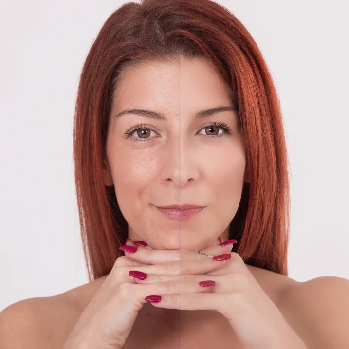Hauterneuerung Behandlung Botox Behandlung für natürlichen Look